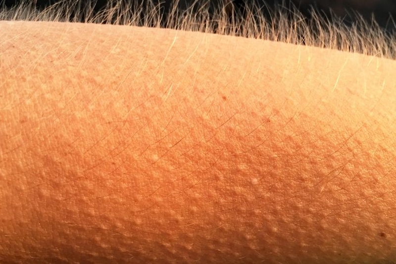 Dị ứng nổi da gà có thể là biểu hiện của viêm nang lông