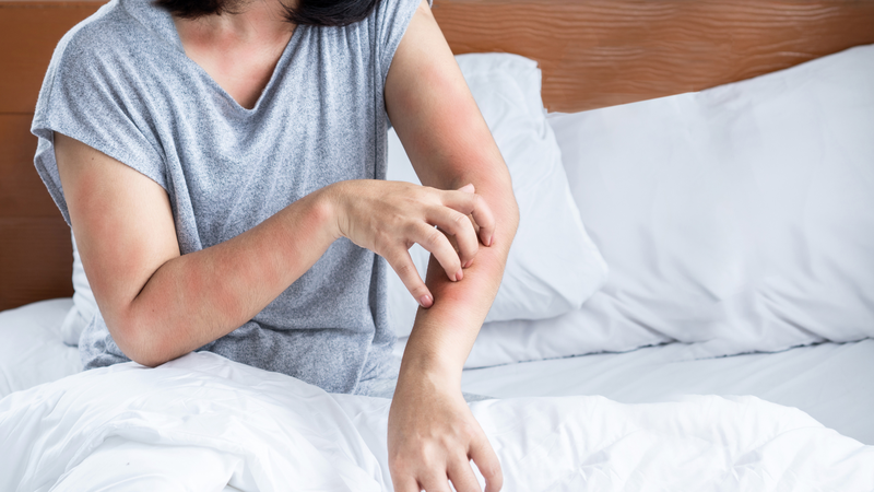 Dị ứng nổi mẩn đỏ gây ngứa ngáy và khó chịu kéo dài