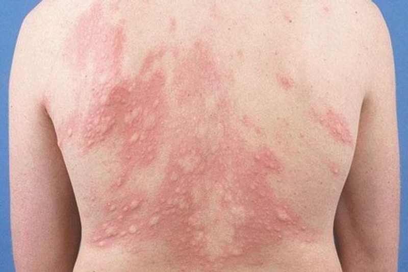 Các triệu chứng và cách điều trị, phòng ngừa bệnh mề đay, mẩn ngứa 1