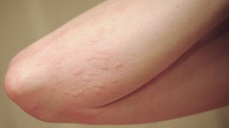 Dị ứng nước biển: Dấu hiệu nhận biết và cách xử lý 3