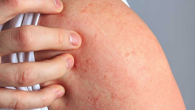 Dị ứng nước biển: Dấu hiệu nhận biết và cách xử lý 1