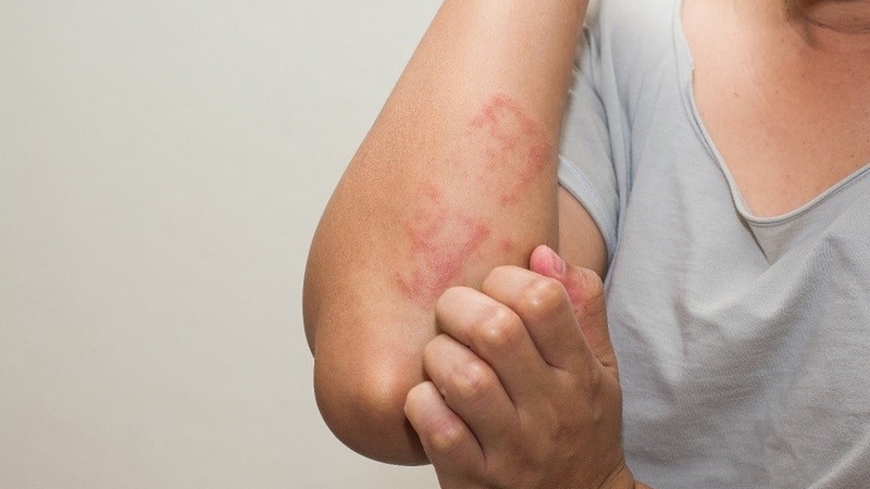 Dị ứng quả đào là gì? Cách chẩn đoán và xử lý kịp thời 3