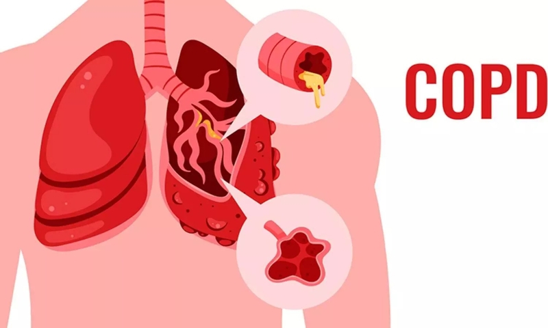 Dị ứng theo mùa và COPD có gì khác nhau trong điều trị? -2
