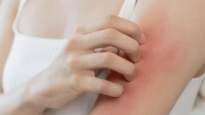 Dị ứng thịt: Nguyên nhân, triệu chứng và cách xử lý 2