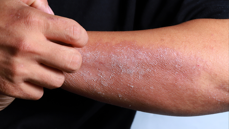 Dị ứng thời tiết là gì? Cách điều trị dị ứng thời tiết 3