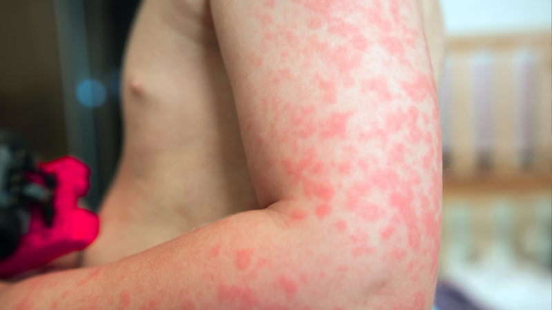 Dị ứng thời tiết là gì? Cách điều trị dị ứng thời tiết 4