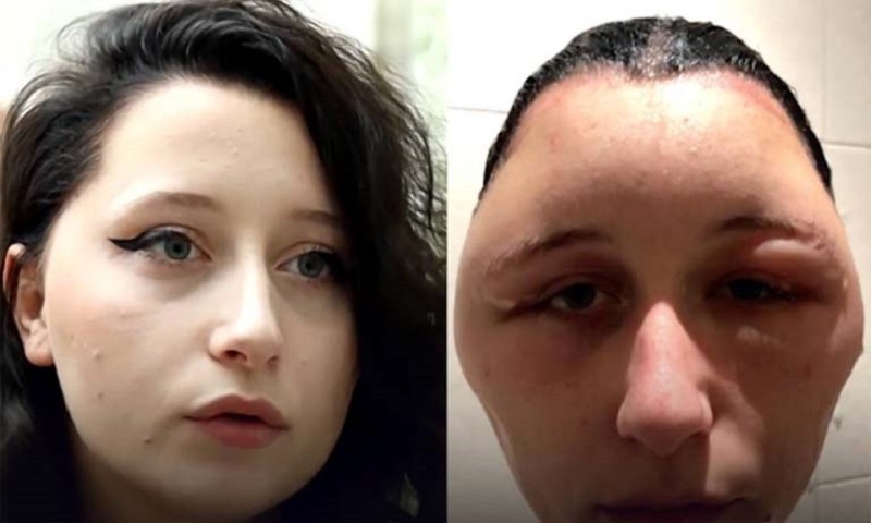 Dị ứng thuốc duỗi tóc là gì? Biểu hiện và cách chữa trị hiệu quả nhất 2