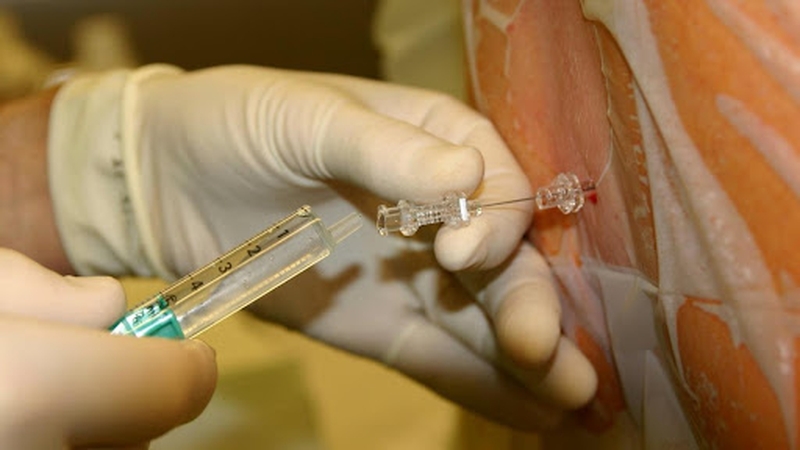 Dị ứng thuốc gây tê tủy sống 1