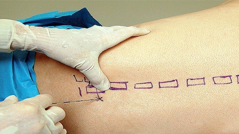 Dị ứng thuốc gây tê tủy sống 2