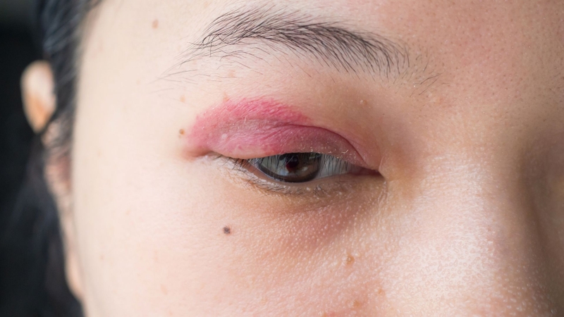 Các chất như benzalkonium chloride có thể gây kích ứng hoặc dị ứng