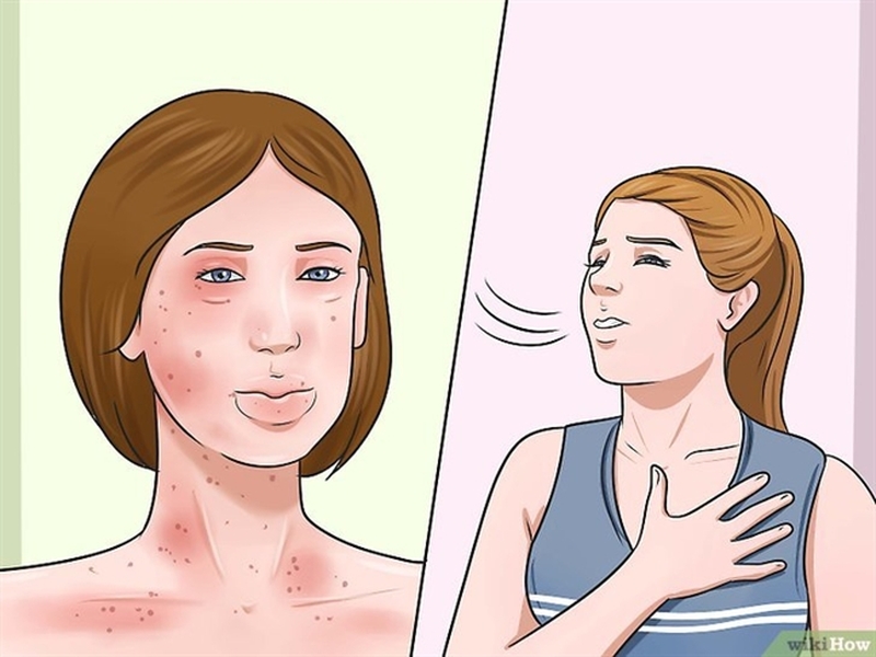 Dị ứng thuốc ở mặt sẽ như thế nào2