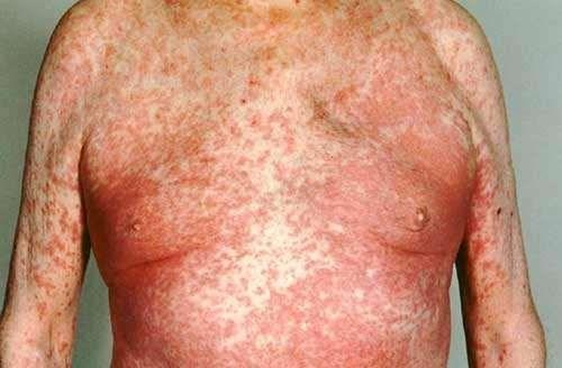 di-ung-thuoc-o-nguoi-gia-va-cach-xu-tri-khi-bi-di-ung-thuoc-o-nguoi-gia 2