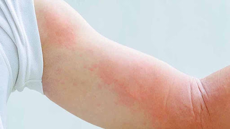 Dị ứng thuốc penicillin và những lưu ý quan trọng 2