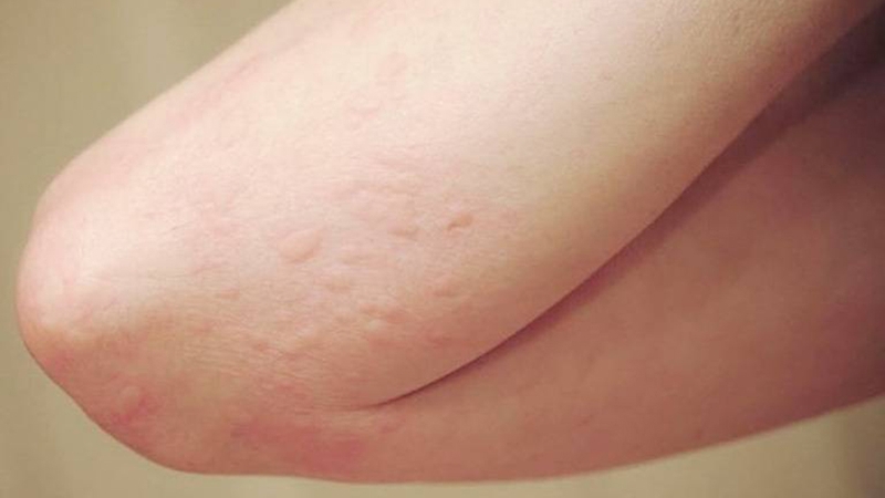 Dị ứng thuốc tê bôi ngoài da có gây nguy hiểm đến tính mạng?