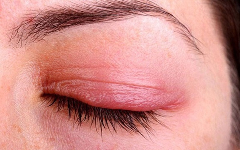 Dị ứng thuốc uốn mi ảnh hưởng đến mắt như thế nào? 3