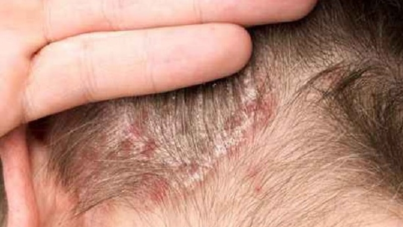 Dị ứng thuốc uốn tóc và những lưu ý khi thực hiện 1