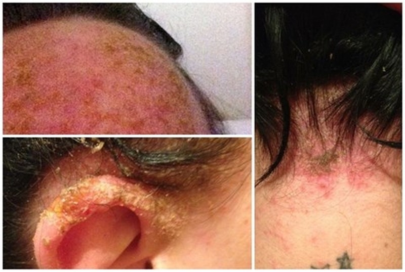 Dị ứng thuốc uốn tóc và những lưu ý khi thực hiện 2