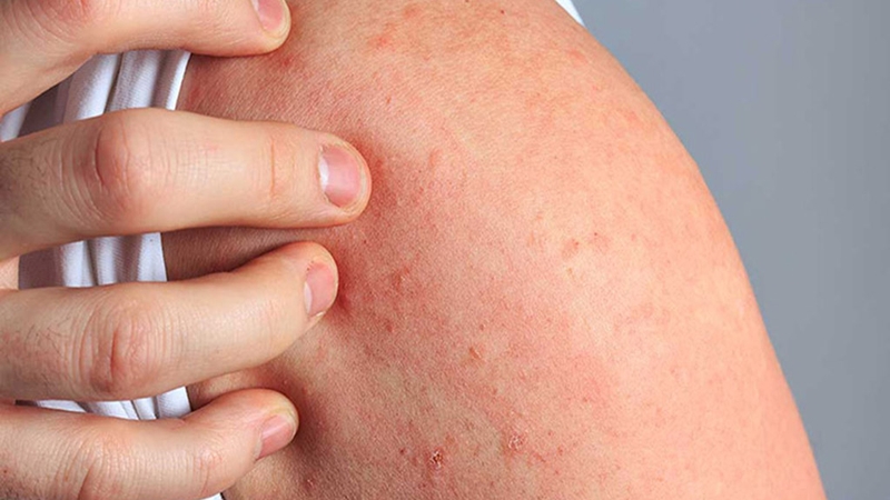 Dị ứng vật nuôi là gì? Nguyên nhân và cách điều trị