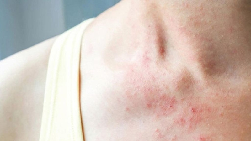 Dị ứng xoài là gì? Nguy hiểm thế nào cho sức khỏe? 2