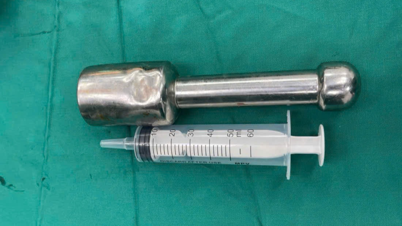 Dị vật được xác định là một chiếc chày dài khoảng 18cm