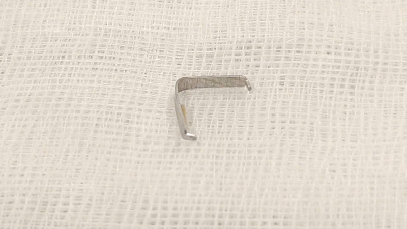 Dị vật phát hiện trong vùng họng bé trai được xác định là một chiếc ghim tất bằng kim loại