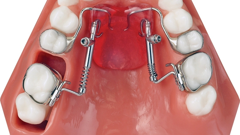 Di xa toàn hàm là gì? Di xa toàn hàm bằng mini vít 1