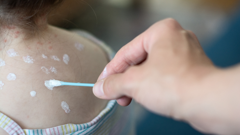 Địa chỉ tiêm ngừa zona ở Bến Tre an toàn, uy tín và chất lượng 1