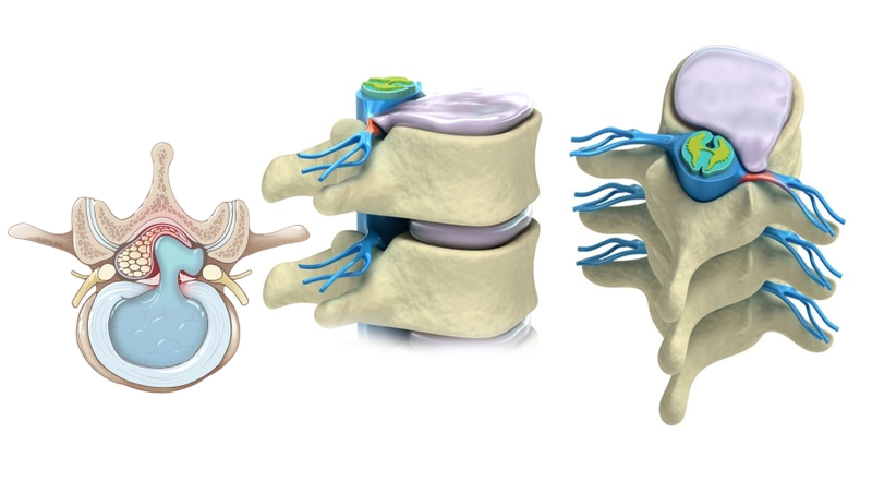 Đĩa đệm là gì? Các bệnh thường gặp ở đĩa đệm 1