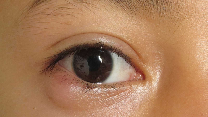 Đĩa thị giác: Cấu tạo, chức năng và một số bệnh lý liên quan 3