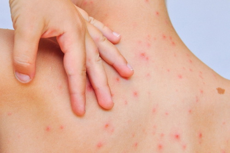 Các biện pháp phòng tránh dịch sởi bùng phát ở trẻ nhỏ 1