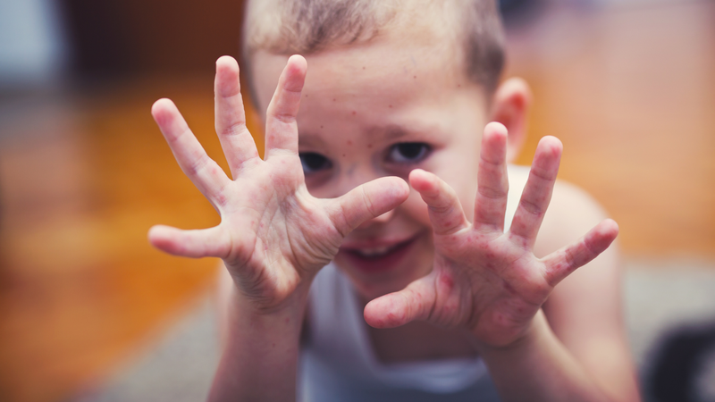 Số ca tay chân miệng tại TP HCM tăng mạnh từ đầu năm 2025