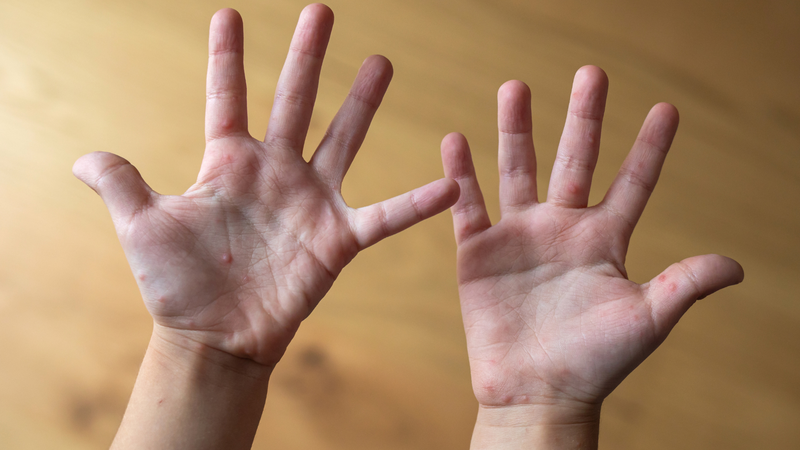 Tăng cường vệ sinh và giám sát để hạn chế lây lan trong trường học