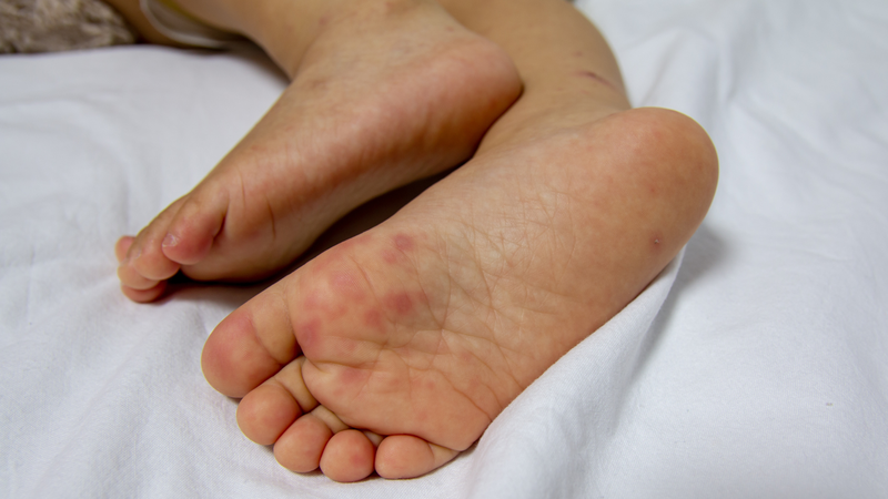 Điều trị chủ yếu giảm triệu chứng, chưa có thuốc đặc hiệu