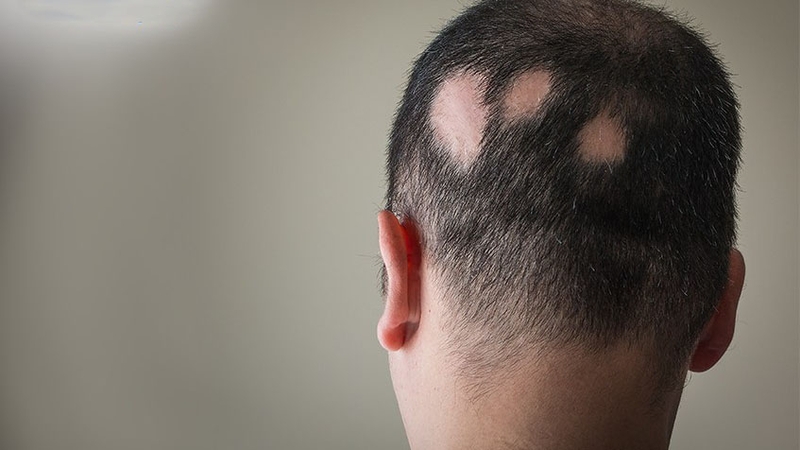 Điểm danh 10 thói quen gây rụng tóc dễ mắc phải 1