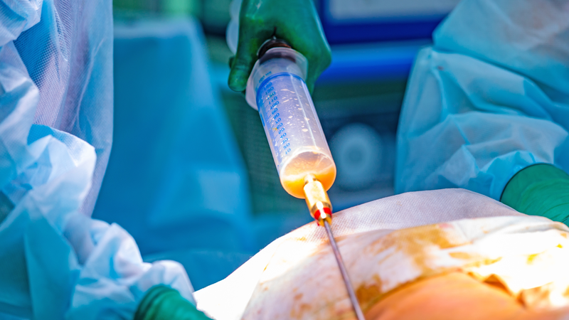 Điểm danh 4 kỹ thuật phẫu thuật thẩm mỹ nên tránh vào mùa hè 4