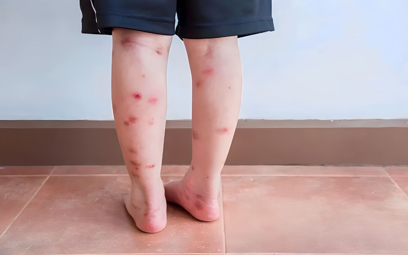 Điểm danh 7 dòng thuốc trị thâm ghẻ ở chân hiệu quả được bác sĩ khuyên dùng nhất 2