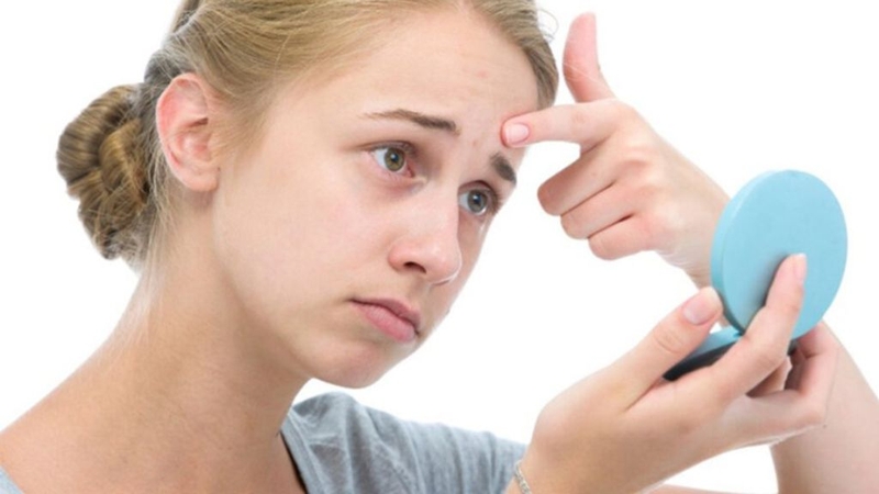 Điểm danh các loại mụn tuổi dậy thì và cách điều trị phù hợp 1