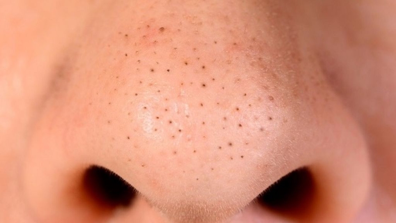 Điểm danh các loại mụn tuổi dậy thì và cách điều trị phù hợp 2