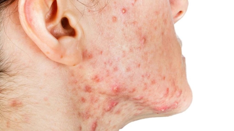 Điểm danh các loại mụn tuổi dậy thì và cách điều trị phù hợp 3