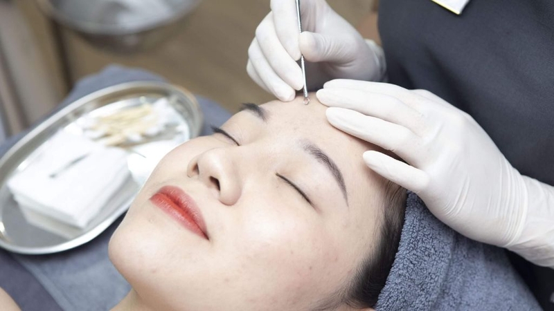 Điểm danh các loại mụn tuổi dậy thì và cách điều trị phù hợp 5