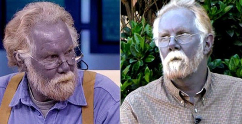 Điểm danh những căn bệnh hiếm gặp nhất thế giới 1