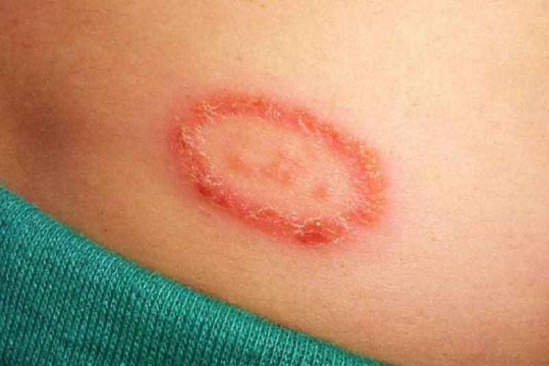 Điểm qua một số hình ảnh bệnh hắc lào ở mông thường gặp nhất