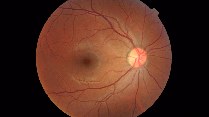 Điểm vàng là khu vực nhạy cảm ở trung tâm võng mạc, quyết định khả năng nhìn sắc nét và tập trung của mắt