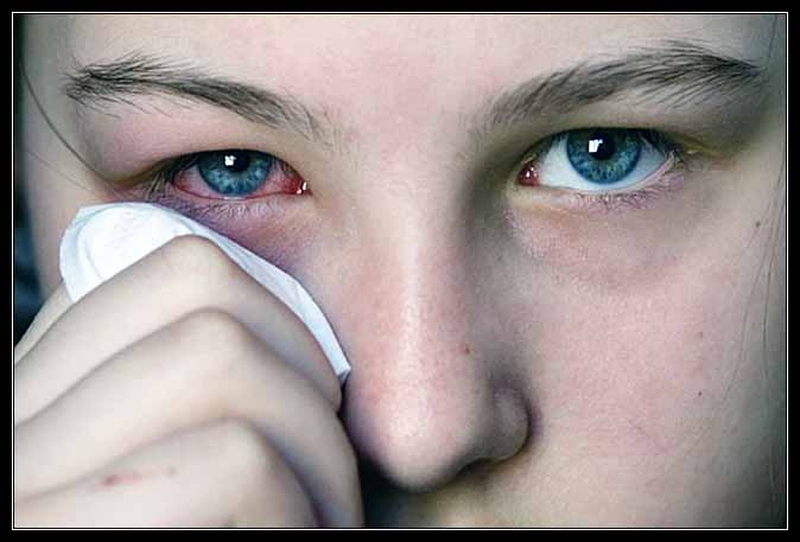 Diễn biến bệnh đau mắt đỏ và cách chăm sóc hiệu quả cho bé