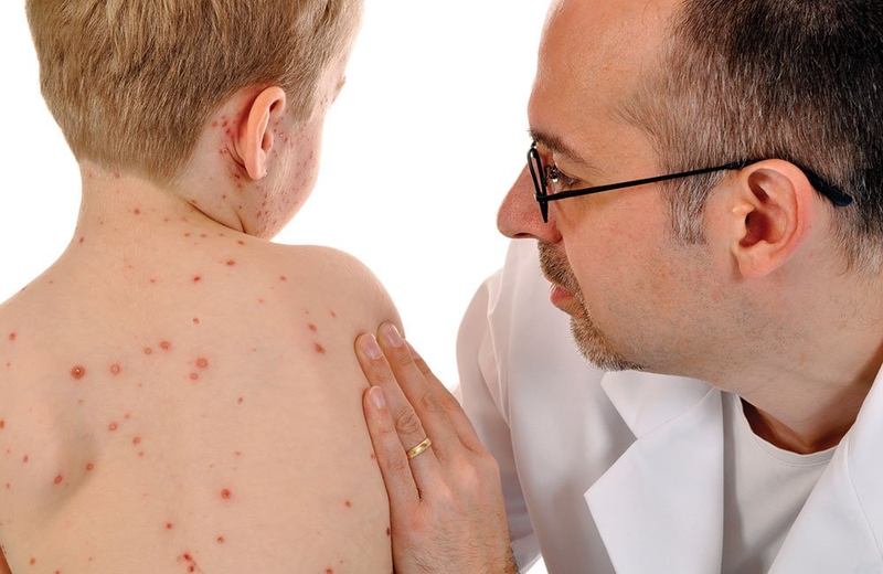 Diễn biến bệnh thủy đậu bạn chớ bỏ qua