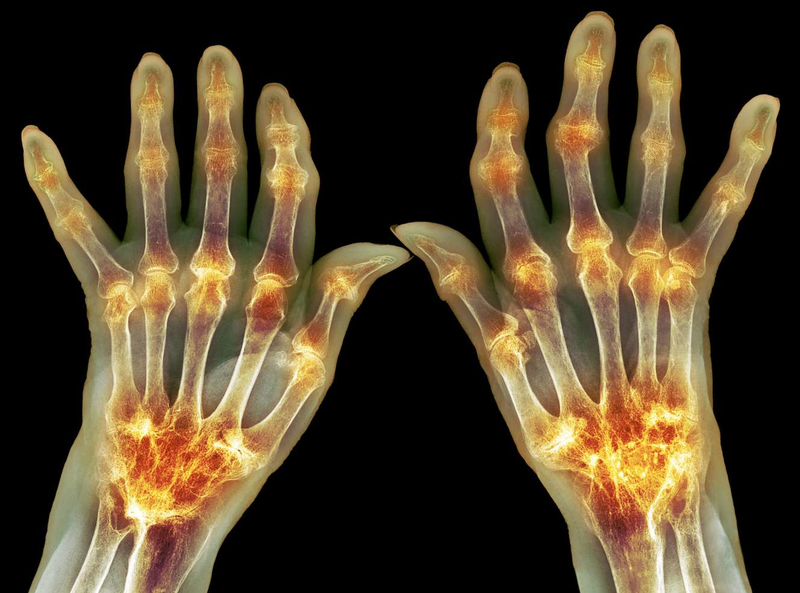 Diễn biến của viêm khớp dạng thấp đa dạng như thế nào? 2