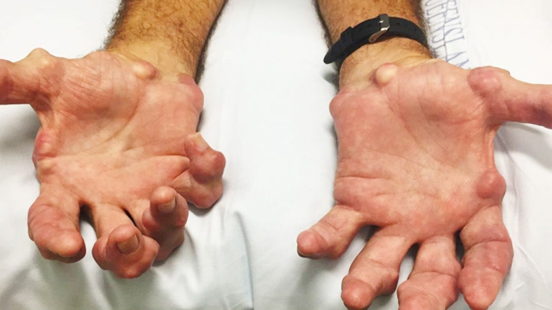 Diễn biến của viêm khớp dạng thấp đa dạng như thế nào? 4