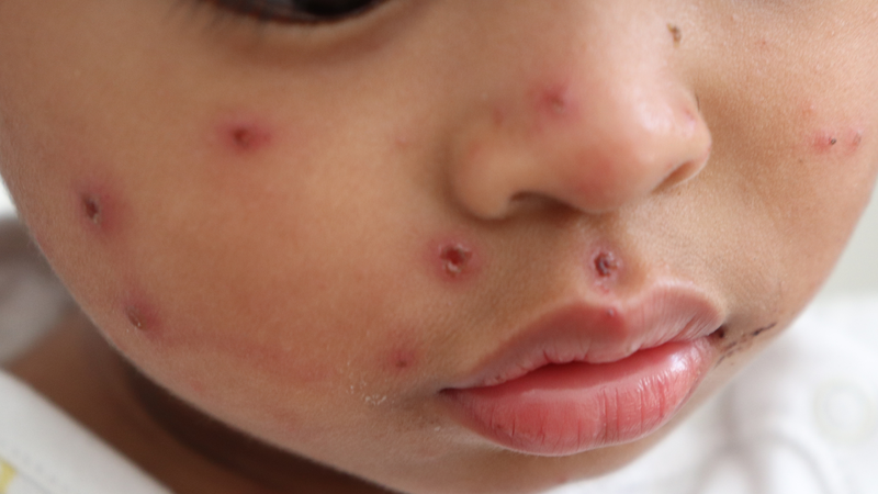 Phát hiện sớm và cách ly kịp thời trẻ nghi mắc sởi giúp hạn chế lây lan trong cộng đồng