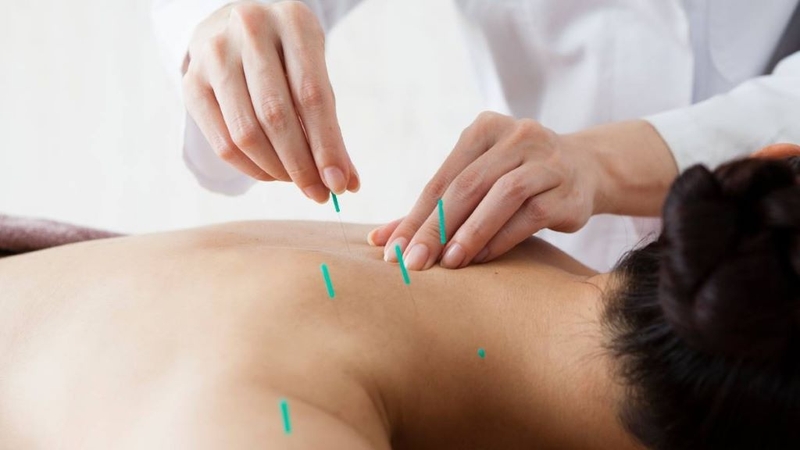 Điện châm chữa đau vai gáy có hiệu quả không? Các bước tiến hành kỹ thuật điện châm 3