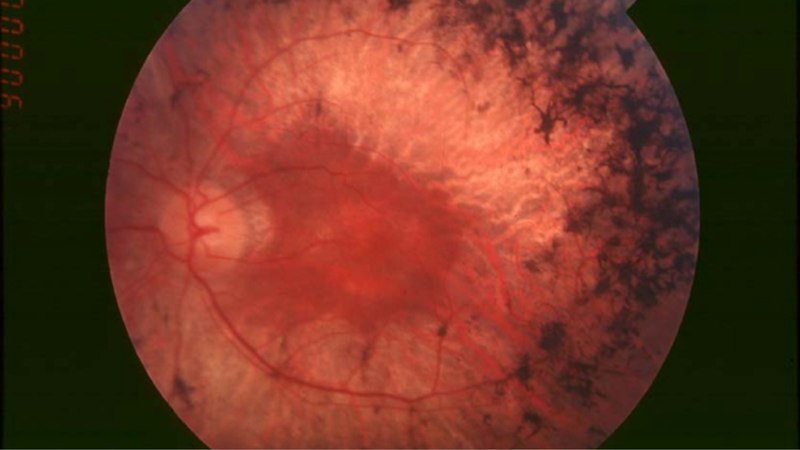 Điện sinh lý mắt là gì? Những lưu ý khi thực hiện các xét nghiệm điện sinh lý mắt 1